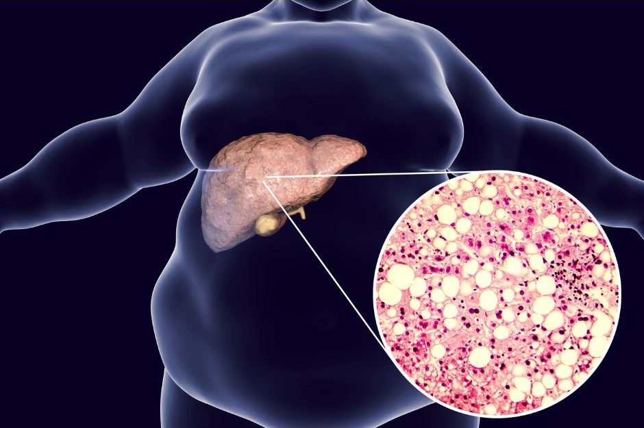 FATTY LIVER DISEASE